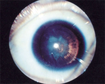 Cataract