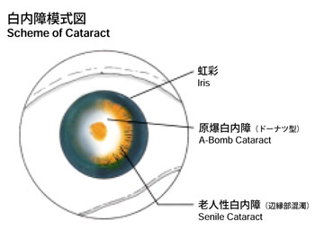 Scheme of cataract