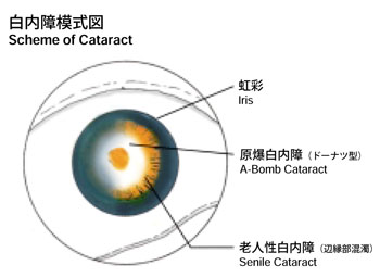 白内障模式図