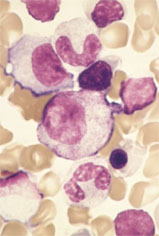 Normal bone marrow