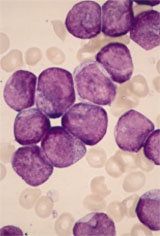 Acute myeloid leukemia