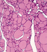 Normal thyroid tissue